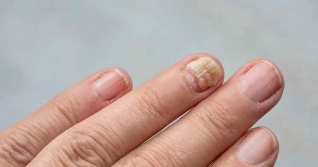 Fingernail Thickness at the Edge